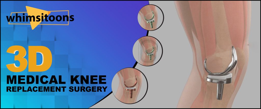 Remove term: 3D Medical Knee Replacement Surgery 3D Medical Knee Replacement Surgery