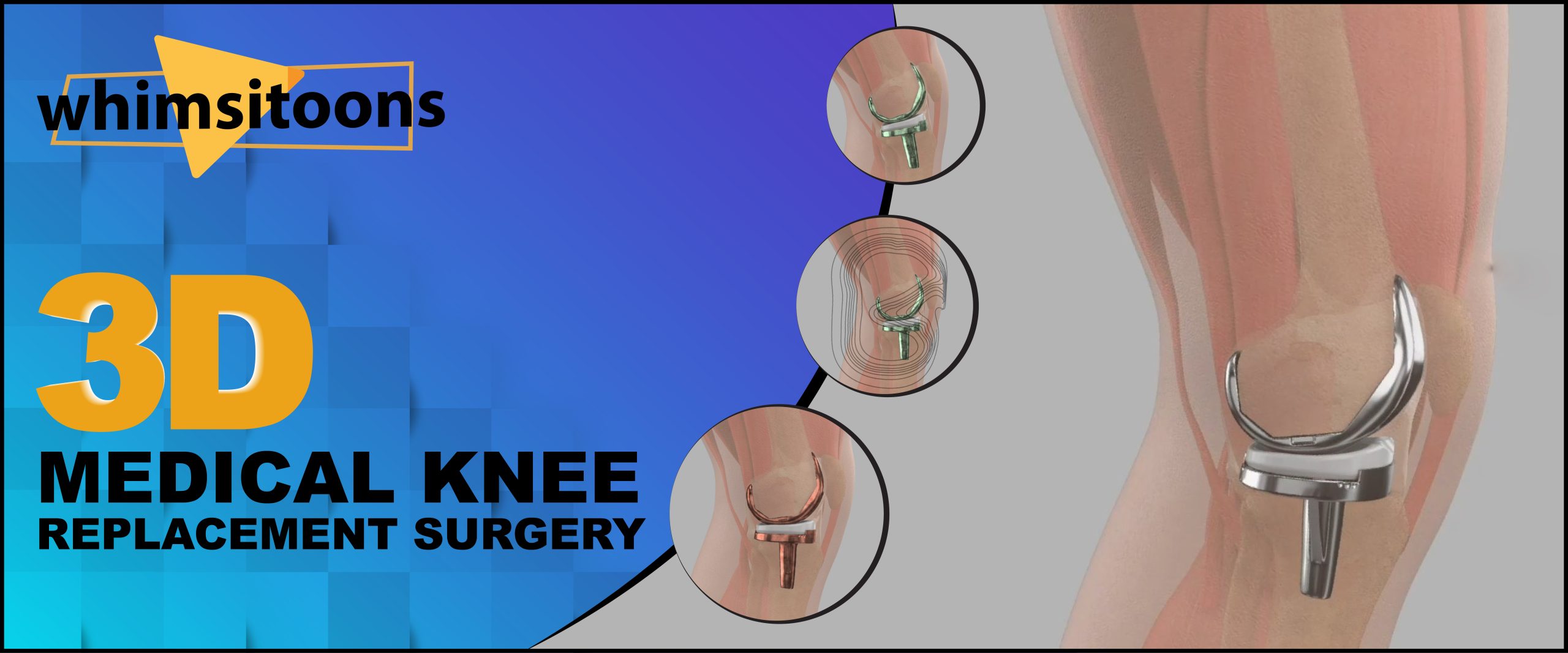 Understand 3D Medical Knee Replacement Surgery With 3D Explainer Videos Image