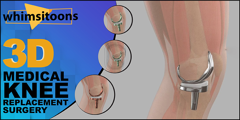 Understand 3D Medical Knee Replacement Surgery With 3D Explainer Videos Image